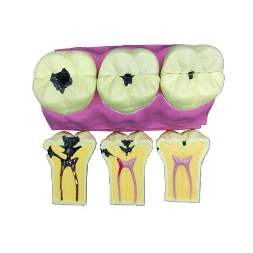 İda Collection Tooth Decay Evolution Model