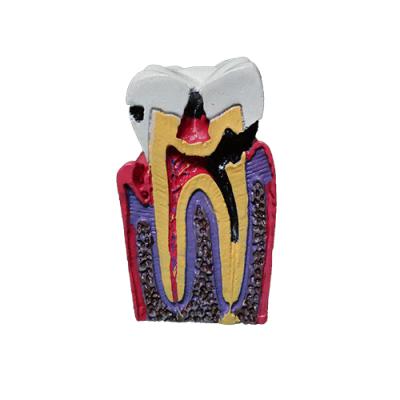 İda Collection Endo model-Diş Çürüğü Modeli